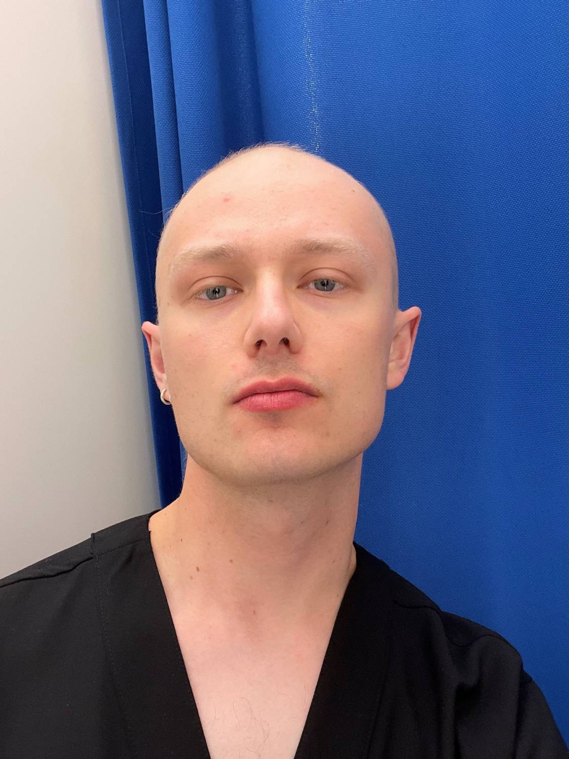 Jonny is in his twenties and has no hair following chemotherapy.